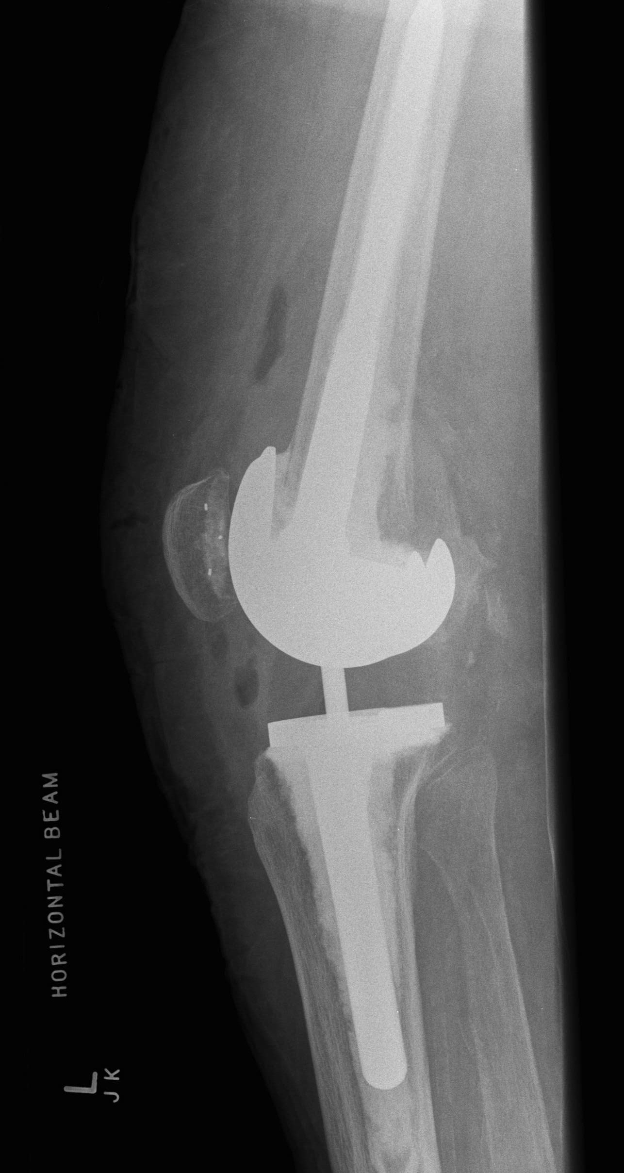 Revision TKR Cemented Stems Lateral